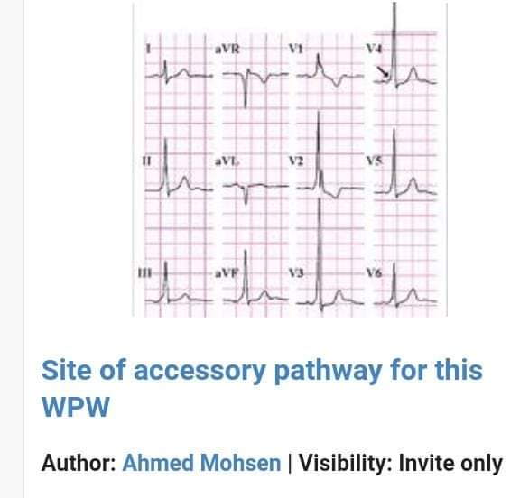 drahmedmohsen85's tweet photo. New ECG  challenge  - Cardiology Quizzes Medshr group! 

Right or left sided accessory pathway? 

Vote now in Medshr!

The correct answer will be provided after 24 hours in Cardiology Quizzes Medshr group
Join now for free from here 
https://t.co/50feC9jvww
#cardiotwitter https://t.co/kKyoKPxQvt