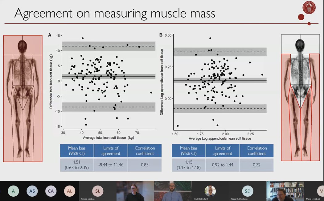 WHAT a week: <a href="/CasperSimonsen7/">Casper Simonsen</a> succesfully defended his PhD thesis on Friday just few days after his latest paper was published on the (dis)agreement between DXA and CT scans for assessment of muscle mass (sarcopenia) in upper GI cancer

Proud Supervisor! 

clinicalnutritionjournal.com/article/S0261-…