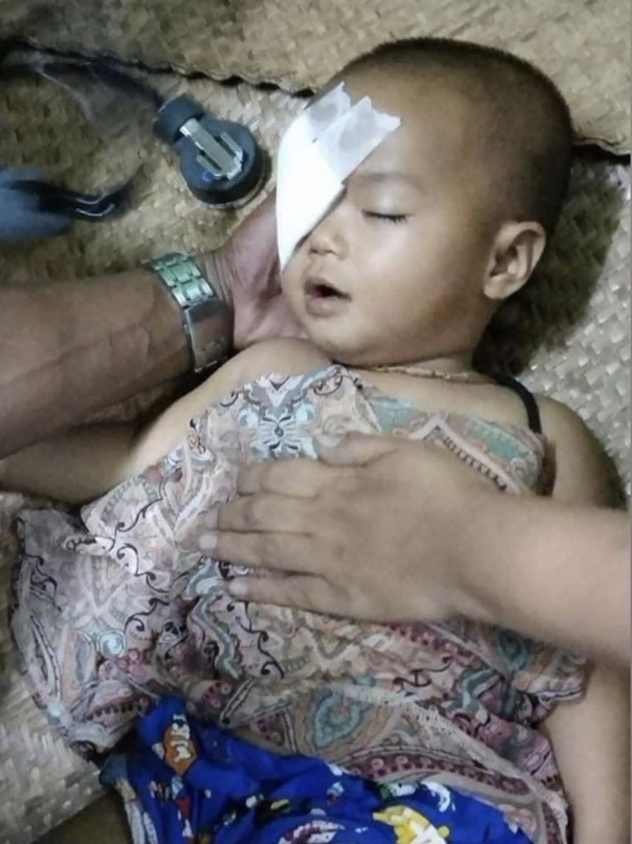 One year infant has been shot in the eye with the rubber bullet by the Myanmar Terroist Police. This is #CrimesAgainstChildren.