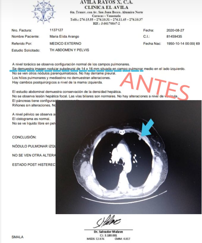 fabiolapasco's tweet photo. AYÚDAME A SALVAR LA VIDA DE MI MAMI  Es paciente oncologico Fue tratada con quimio y esta no hizo efecto. Hoy requiere hacerse con suma urgencia unas radioterapias especializadas IMRT Su lesión seguirá aumentando y no se podrá hacer nada si nos se las hace. ⏬⏬⏬ https://t.co/UzdzPvcsuk