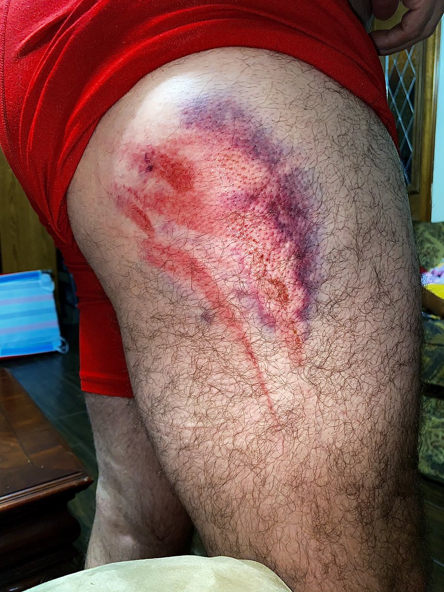 SquidneyCC's tweet photo. My fiancé’s leg after a rugby match looks like the fish on spongebob 🧐
#Rugby  #spongebob https://t.co/ZXN82T2Ncv