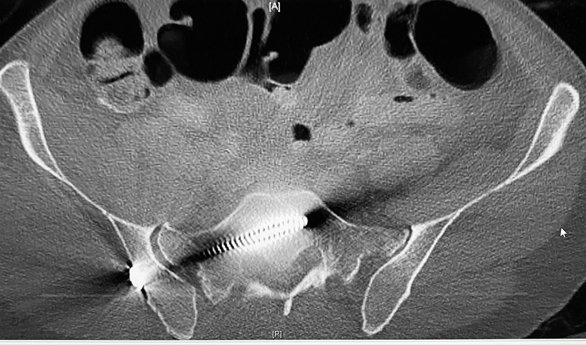 What will you do for this 50yo active male with an isolated closed pelvic ring injury? He was injure...