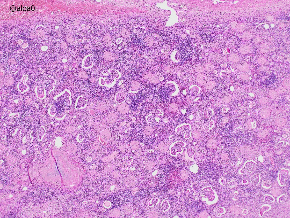 aloa0's tweet photo. Non-functioning kidney with stones.  Multiple minute papillary adenoma-like structures are noted in the cortex. A papillary adenoma (size 1 mm) is also found (pic3). The medulla shows granulomatous reaction to stone crystals. #GUpath https://t.co/kmyxK9KVc1
