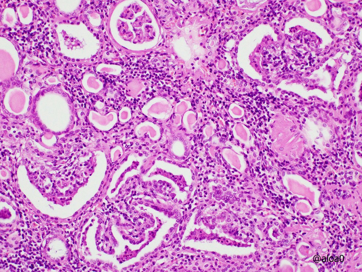 aloa0's tweet photo. Non-functioning kidney with stones.  Multiple minute papillary adenoma-like structures are noted in the cortex. A papillary adenoma (size 1 mm) is also found (pic3). The medulla shows granulomatous reaction to stone crystals. #GUpath https://t.co/kmyxK9KVc1