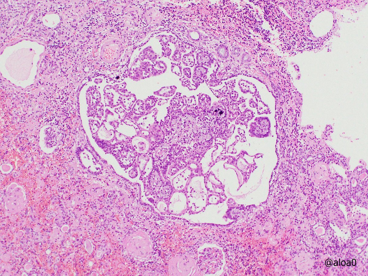 aloa0's tweet photo. Non-functioning kidney with stones.  Multiple minute papillary adenoma-like structures are noted in the cortex. A papillary adenoma (size 1 mm) is also found (pic3). The medulla shows granulomatous reaction to stone crystals. #GUpath https://t.co/kmyxK9KVc1