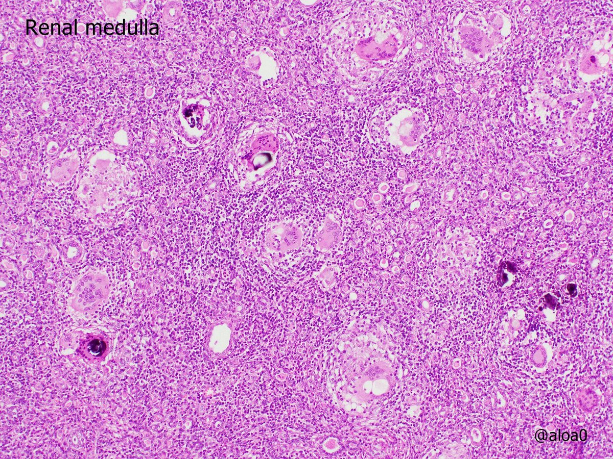 aloa0's tweet photo. Non-functioning kidney with stones.  Multiple minute papillary adenoma-like structures are noted in the cortex. A papillary adenoma (size 1 mm) is also found (pic3). The medulla shows granulomatous reaction to stone crystals. #GUpath https://t.co/kmyxK9KVc1