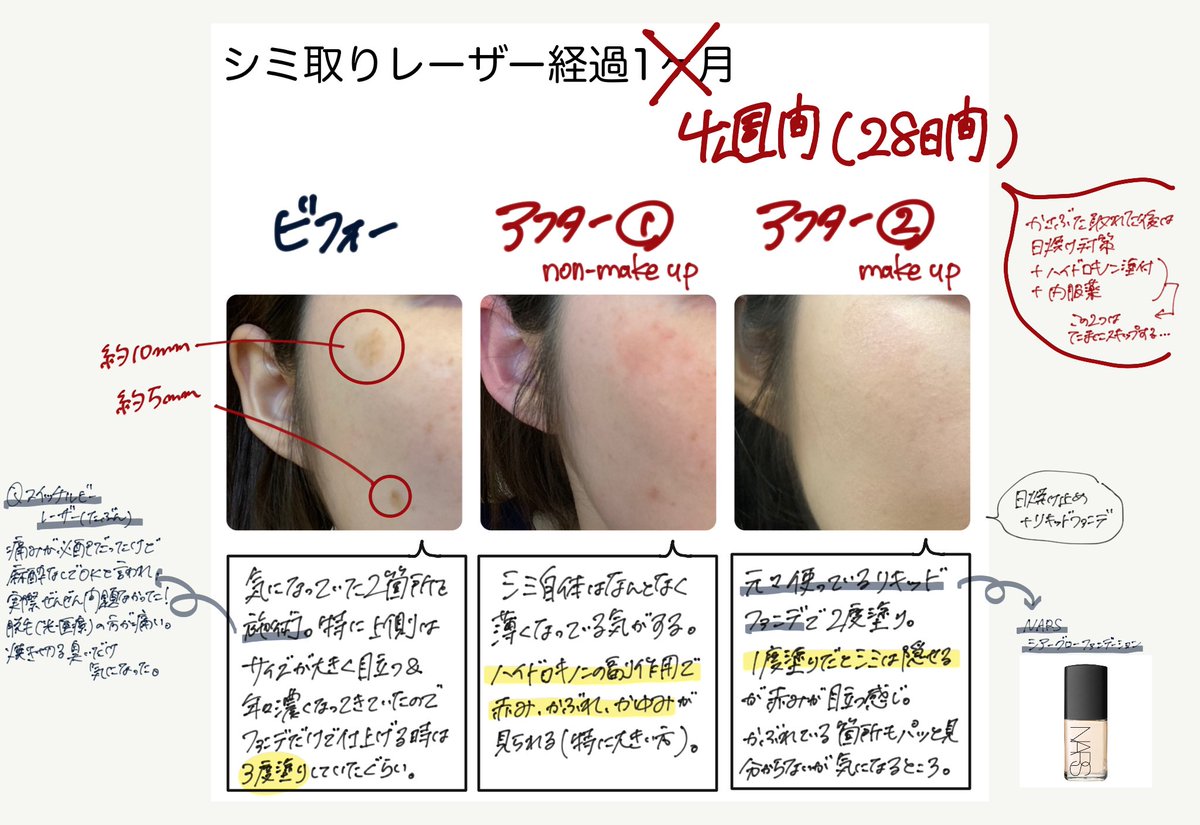 シミ取りレーザー シミ取りレーザー