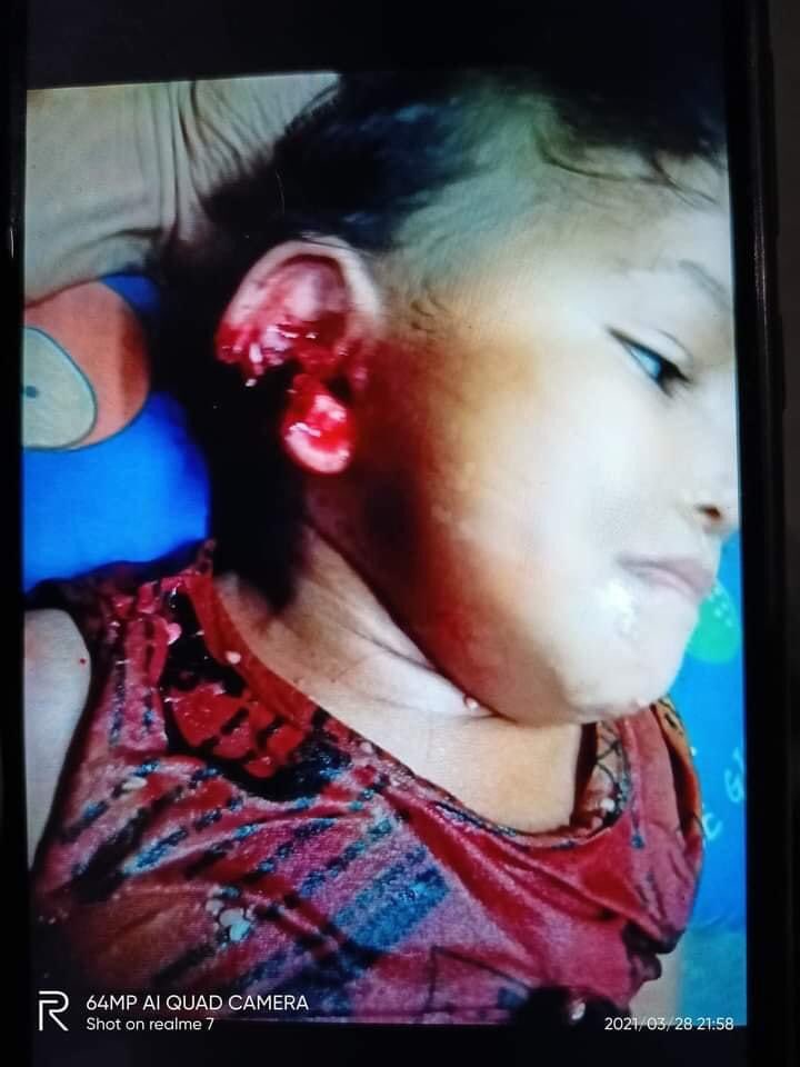 Tw// blood and violence
One and a half year old girl was shot in the ear by SAC terrorists in South Dagon tsp, Yangon. Please stop hurting our children. 
#WhatsHappeningInMyanmar 
#Mar28Coup 
<a href="/UN/">United Nations</a> <a href="/hrw/">Human Rights Watch</a> <a href="/UNICEF/">UNICEF</a>