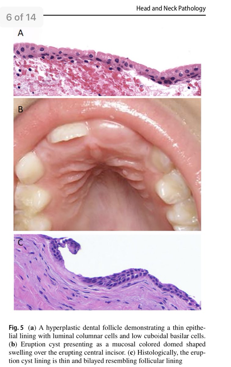 SaudiODSC's tweet photo. #Odontogenic and Developmental Oral Lesions in #Pediatric Patients [open access]

https://t.co/BpWXGRolfH https://t.co/qOeqehtYtR