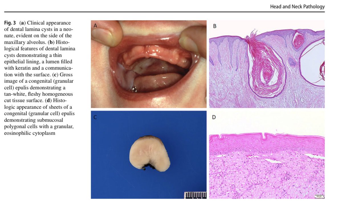SaudiODSC's tweet photo. #Odontogenic and Developmental Oral Lesions in #Pediatric Patients [open access]

https://t.co/BpWXGRolfH https://t.co/qOeqehtYtR