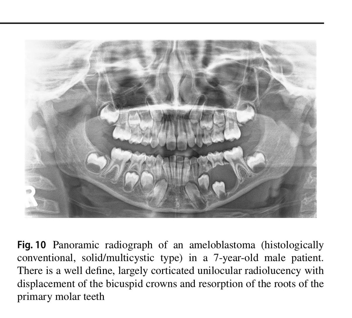 SaudiODSC's tweet photo. #Odontogenic and Developmental Oral Lesions in #Pediatric Patients [open access]

https://t.co/BpWXGRolfH https://t.co/qOeqehtYtR
