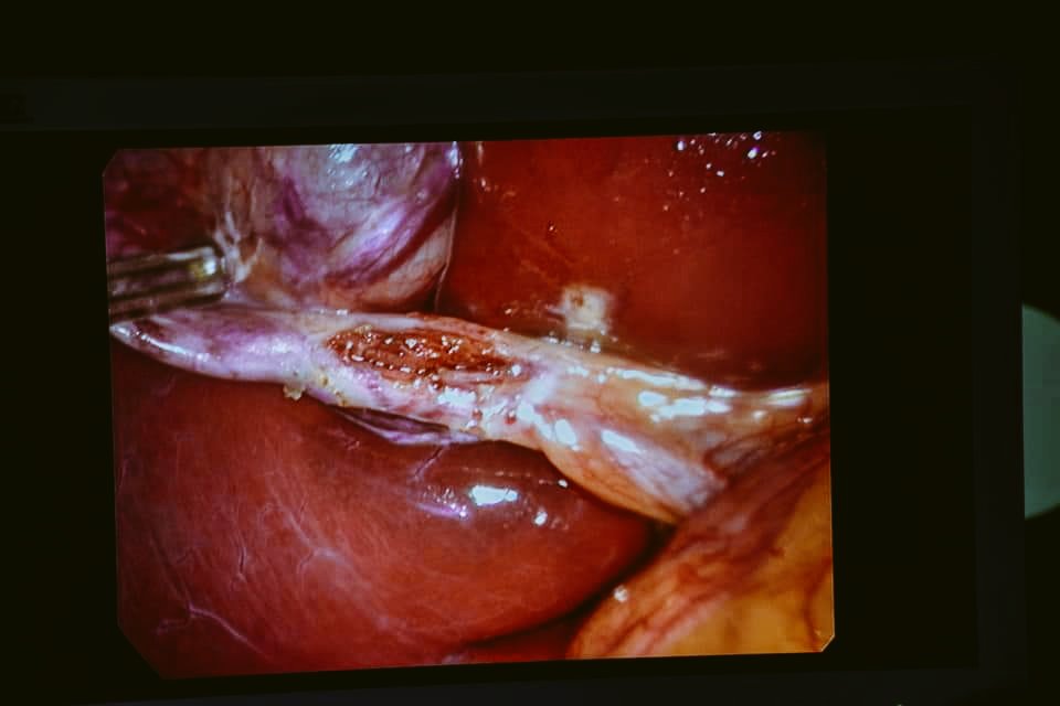 nasser_elobidi's tweet photo. #laparoscopic_cholecystectomy https://t.co/CvZan81UcA