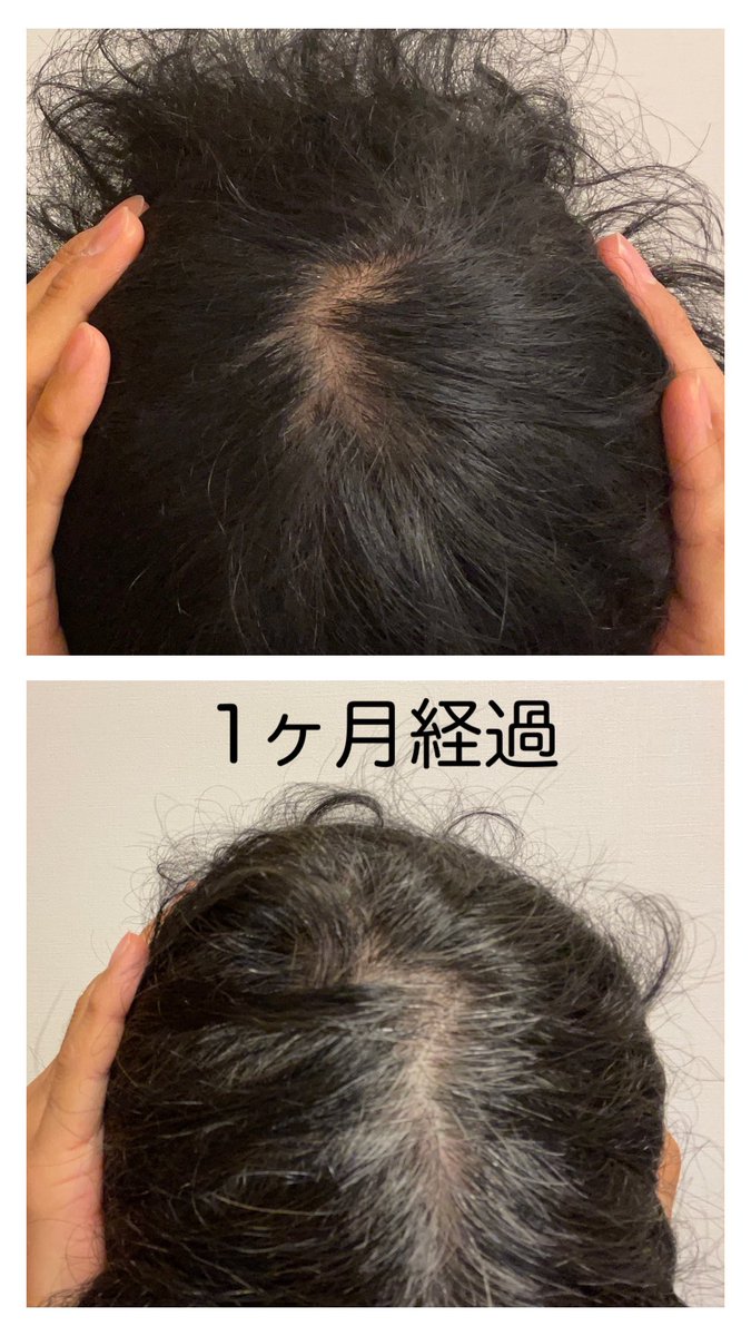 初期脱毛 初期脱毛