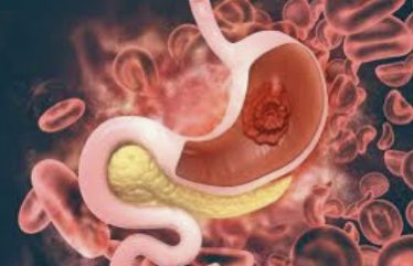 SURGERY Journal (@surgjournal) on Twitter photo Ninety-day mortality after total gastrectomy for gastric cancer
<a href="/pennsurgery/">PennSurgery</a> #SoMe4Surgery
surgjournal.com/article/S0039-… Ninety-day mortality after total gastrectomy for gastric cancer
<a href="/pennsurgery/">PennSurgery</a> #SoMe4Surgery
surgjournal.com/article/S0039-…