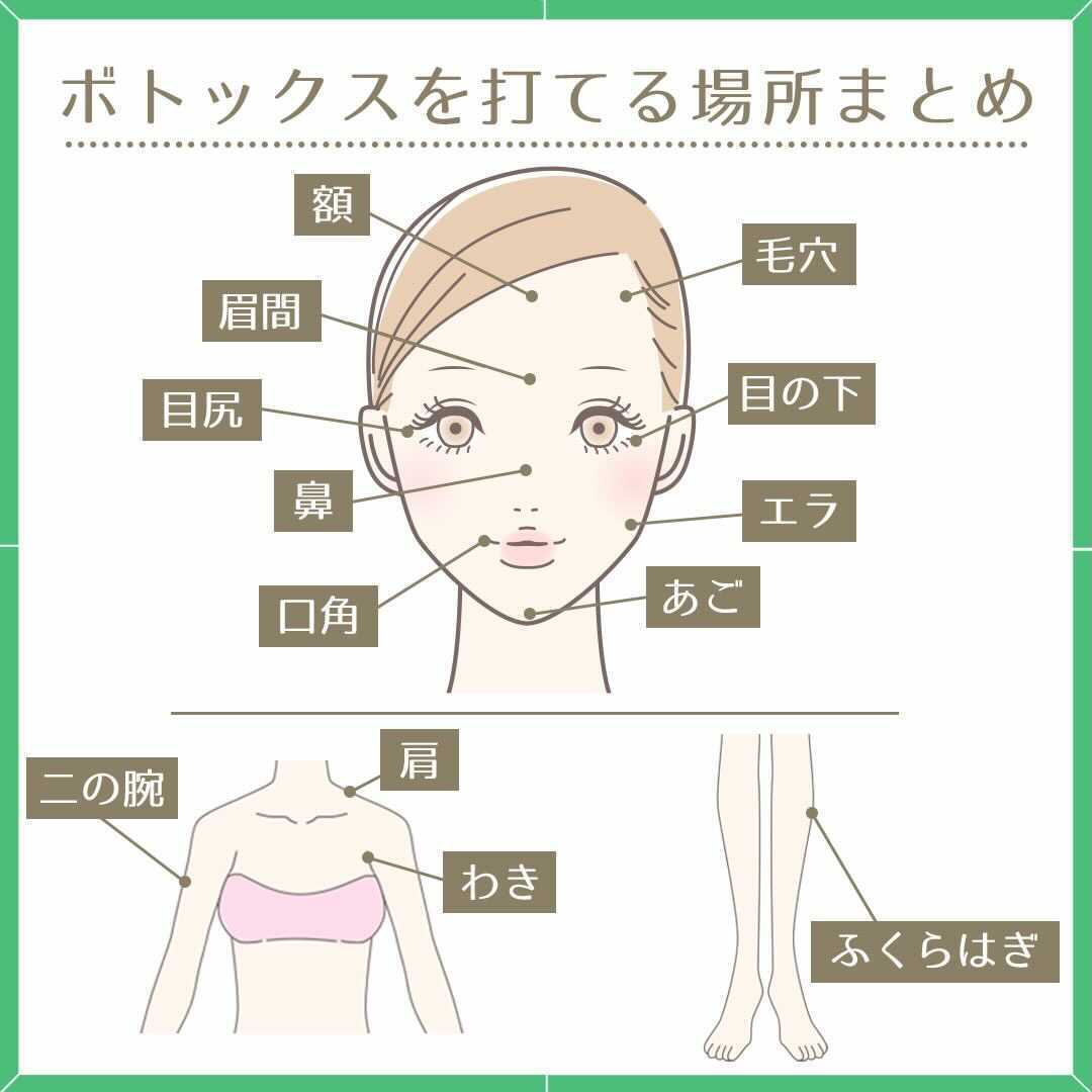 Uzivatel キレイパスbygmo 公式 Na Twitteru ボトックスを打てる場所は 美容医療ではポピュラーなボトックス ですが 有名な エラボトックス の他にも しわ改善など様々な部位に打つことができます どんな施術があるのかをまとめてみました 施術の際は