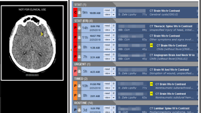 Radiology_AI's tweet photo. #DeepLearning algorithm for intracranial hemorrhage detection reduced head CT turn-around times https://t.co/XCcn5tdH5F @UTSW_Radiology #triage #headCT #MachineLearning https://t.co/bLsCInTI9W