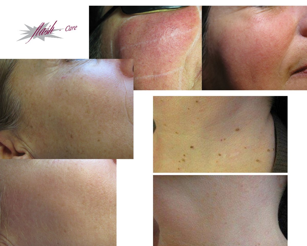 FlashCare's tweet photo. MODEL gezocht voor vrijdag middag 16 april. In Woerden bij de ANBOS.   Heb jij last van vlekjes, plekjes, wratjes, vaatjes èn tijd?  En wil je daar iets aan laten doen? Mail me dan; info@flash-care.nl https://t.co/OrdIwK2OqL