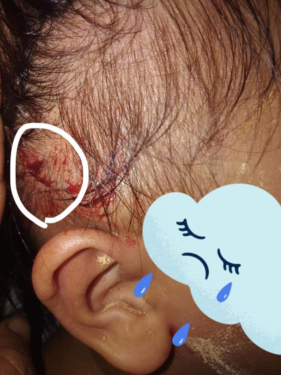 zuzue1939's tweet photo. Tw // blood 

A two-year-old kid was hit in the head by live ammunitions in South Dagon 54 ward.

JUNTA MASSACRE
#WhatsHappeningInMyanmar
#Mar29Coup 
#CrimesAgainstChildren 
#SaveChildrenInMyanmar 
#savemyanmar https://t.co/VAjGu9wHk9