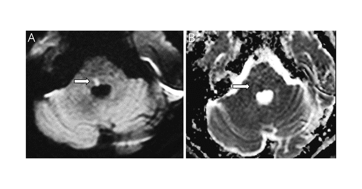 GreenJournal's tweet photo. Teaching Video NeuroImages: From 9 to 8-and-a-Half Syndrome After tPA: The Rebirth of Fellini https://t.co/gHHJFgq0E7 #Neurology #NeurologyRF https://t.co/lT5Yf0ozim