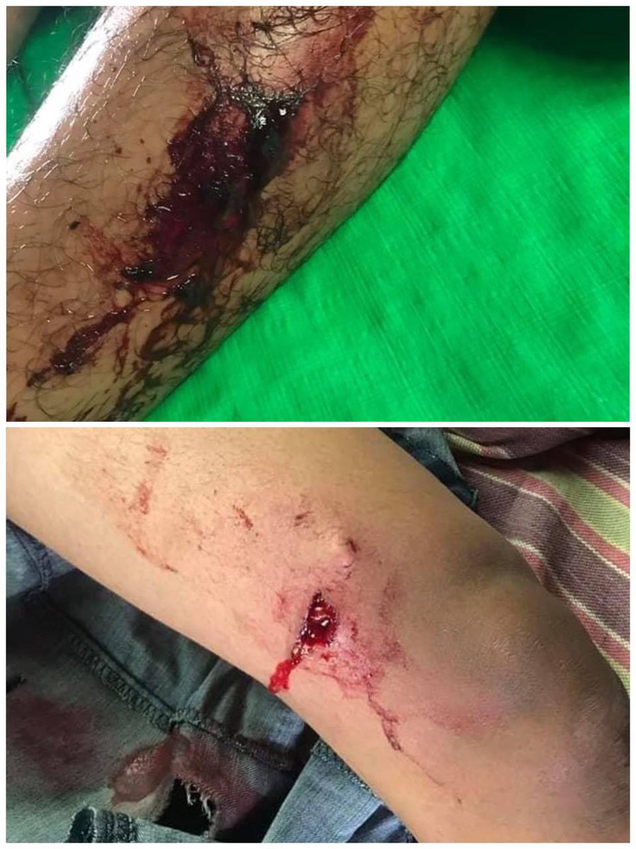 tw // blood // wound
In Kalay City, Junta (SAC) violently crake down and 4 protestors from Women For Justice team have died and around 20 people were injured.
Rest in Power Brave Girls
JUNTA MASSACRE
#Mar29Coup
#WhatsHappeningInMyanmar