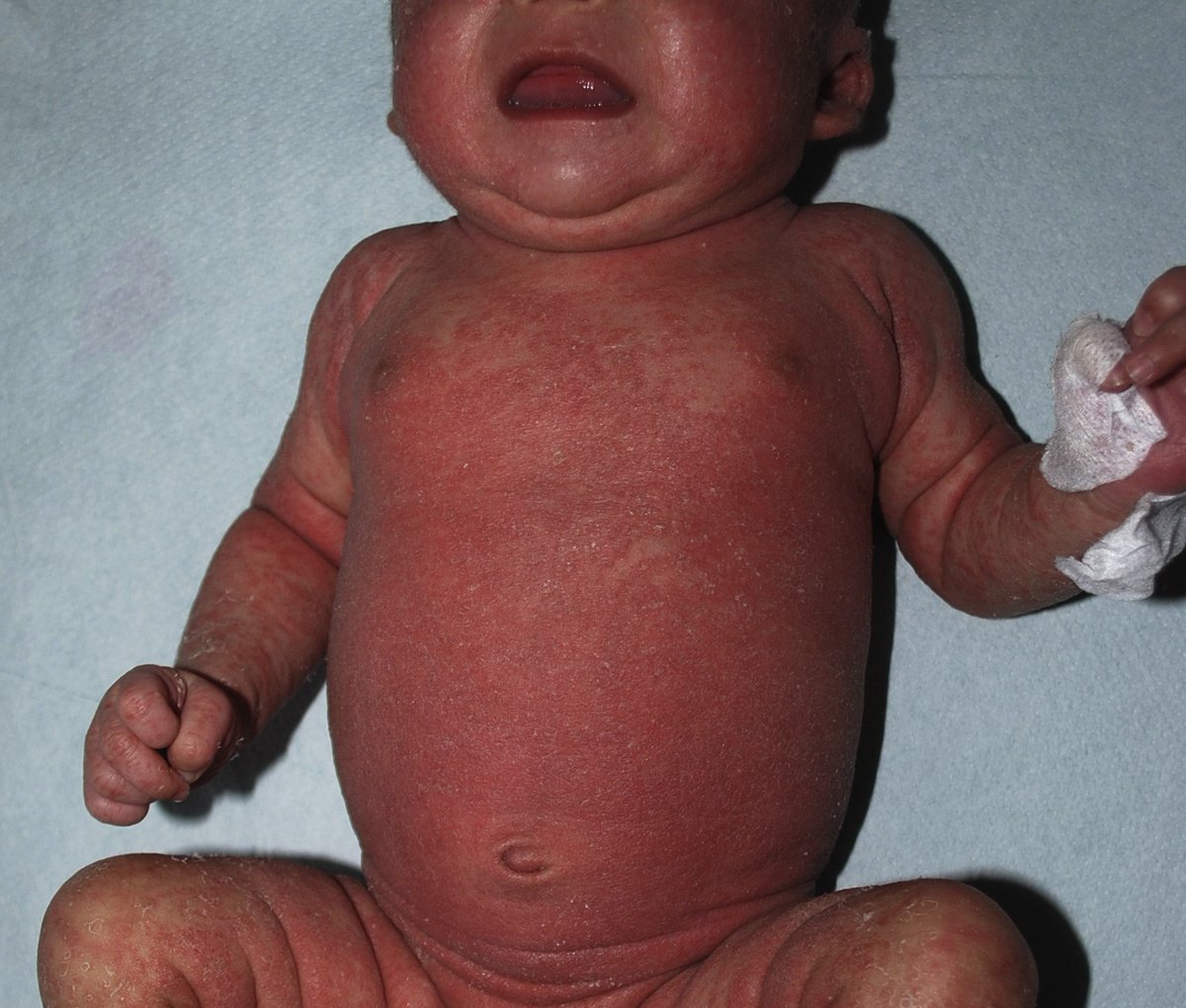 JPediatr's tweet photo. Neonatal #erythroderma can be the primary manifestation of a broad spectrum of disorders. Isolated erythroderma in a 20 day-old baby led to an early diagnosis of Omenn Syndrome. @gustodicuracao #newborn #primaryimmunodeficiency #omenn https://t.co/wezj0vIxHX https://t.co/vOmypVVWZe
