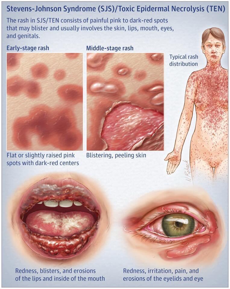 dr16z's tweet photo. ❌ دواء Metronidazole الي اسمه التجاري فلاجيل (Flagyl) ما نعطيه ابدا مع دواء Mebendazole الي اسمه التجاري( Vermox) 

⚠️ لانه يسبب متلازمة Steven Johnson syndrome 
الي هي تدمير خلايا الجلد وتأكل بالجلد 

🔹واذا اردت ان  تعطيهم يكون الفصل بين الدوائين اسبوع بينهم لتجنب هذا التداخل https://t.co/DfKy67CuBi