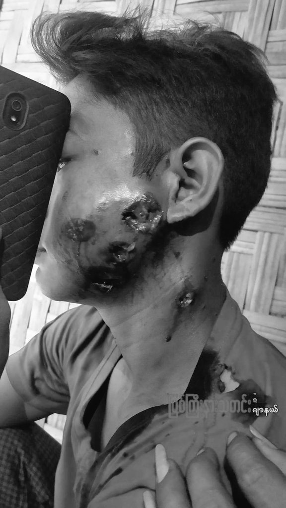 DandanieMyanmar's tweet photo. tw// Graphic Warning ⚠️ // Violence
Look this  young boy who got shot to the face brutally with rubber bullets by Min Aung Hlaing's military terrorists in Myitkyina Tsp, Kachin State this evening.

#Mar29Coup
#WhatsHappeningInMyanmar 
#OpCCP https://t.co/6rw9lu2Gg2
