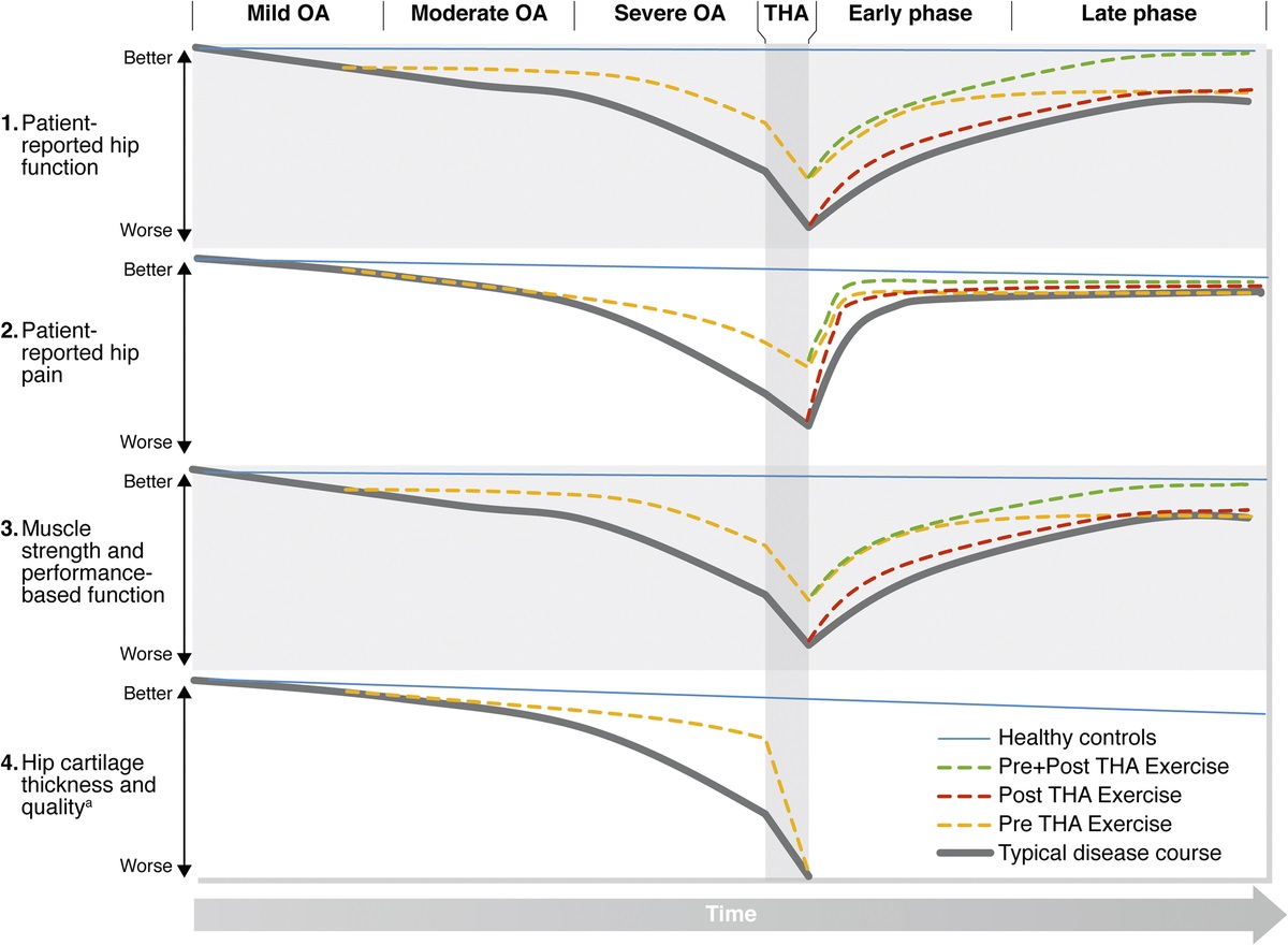 ESSRonline's tweet photo. Exercise is primary, secondary, or tertiary prevention at different stages of hip osteoarthritis (preclinical, mild-moderate, and severe hip osteoarthritis) and after total hip arthroplasty.
https://t.co/dVYxID8TVR https://t.co/Hbhq58TtsV