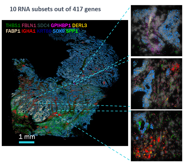 vizgen_inc's tweet photo. MERSCOPE was used to map the expression of 417 genes across a #coloncancer section. This global, single-cell view will help uncover interactions between cells &amp; confirm pathways &amp; mechanisms that could provide key insights to overcome this disease.  #coloncancerawarenessmonth https://t.co/Pv4fN8hezJ