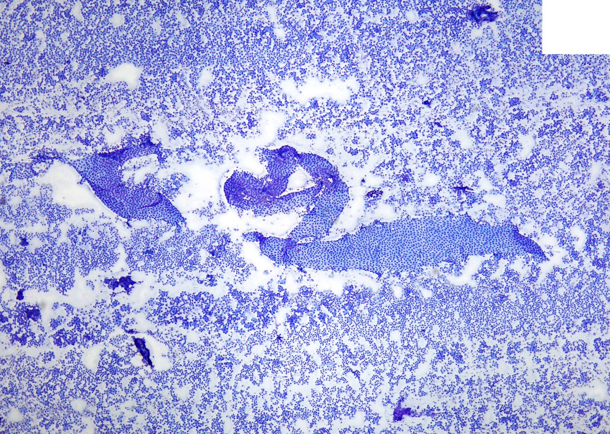 sza_jhcyto's tweet image. &quot;NEVER forget the path of the traversing FNA needle&quot;. Liver mass in a 50/M with history of &quot;Pancreatic Neuroendocrine Tumor (PanNET)&quot;. The flat sheets of mesothelial cells present a beautiful and eye-catching contrast with the background metastatic PanNET.