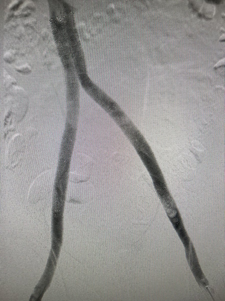 Kush Desai (@kush_r_desai) on Twitter photo Severe venous claudication at 1 block due to IVCF-related complete infrarenal occlusion. #filterOUT and double barrel 14 mm (IVC/iliac) and bilateral 12 mm (CFV) reconstruction. 1 week later, going on walks for a mile! <a href="/NorthwesternIR/">NorthwesternIR</a> <a href="/SIRspecialists/">Society of Interventional Radiology</a> <a href="/NUFeinbergMed/">Northwestern Feinberg School of Medicine</a> <a href="/NURadiology/">Northwestern Radiology</a> Severe venous claudication at 1 block due to IVCF-related complete infrarenal occlusion. #filterOUT and double barrel 14 mm (IVC/iliac) and bilateral 12 mm (CFV) reconstruction. 1 week later, going on walks for a mile! <a href="/NorthwesternIR/">NorthwesternIR</a> <a href="/SIRspecialists/">Society of Interventional Radiology</a> <a href="/NUFeinbergMed/">Northwestern Feinberg School of Medicine</a> <a href="/NURadiology/">Northwestern Radiology</a>