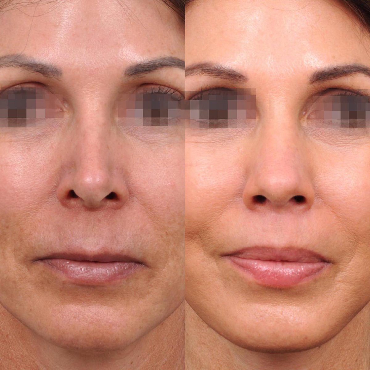DrBenTalei's tweet photo. #RevisionRhinoplasty and Deep Plane #UpperLipLift
This rhinoplasty required rib cartilage and composite ear grafts to help soften the appearance. The lip lift simply helped restore contour, balance and sensuality. 
See more angles on Instagram: @lipliftbydrbentalei https://t.co/MbWIr4LVCf