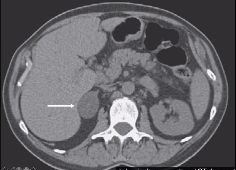 bhgross144's tweet photo. Wen Shen's presentation also focuses on CT scanning, in this case, the way that the technology facilitates the discovery of adrenal incidentaloma--an enlargement of the adrenal gland in patients w/o other signs of adrenal disease.

#histmedtech2021 https://t.co/2UoUZuquvz