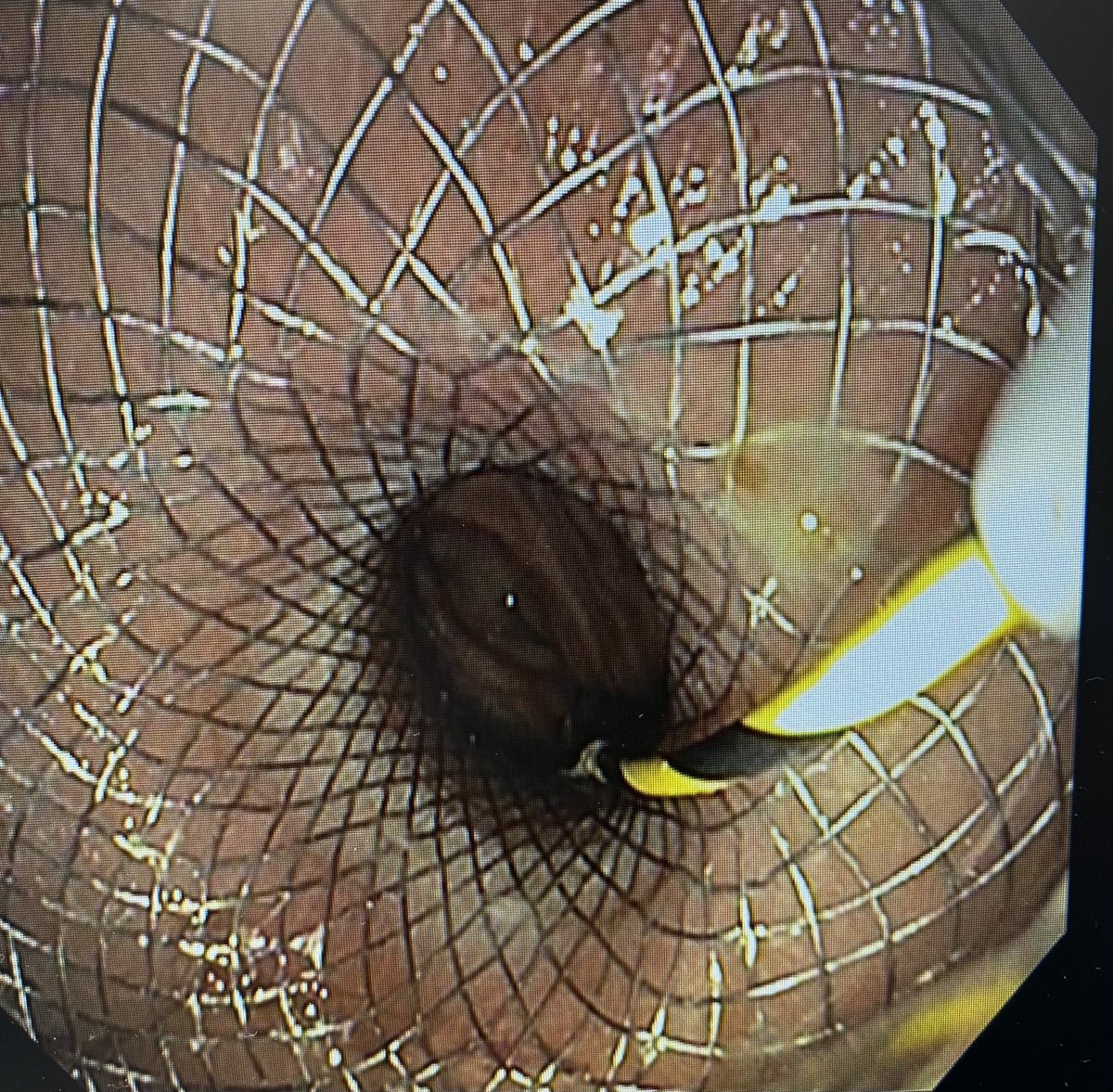 VMehendirattaMD's tweet photo. Capped off the inpatient week ⁦@hartfordhosp⁩ #giconsult service with #EUS Guided Gastrojejunostomy using #Axios stent for malignant duodenal obstruction https://t.co/3jd7wwdbiz