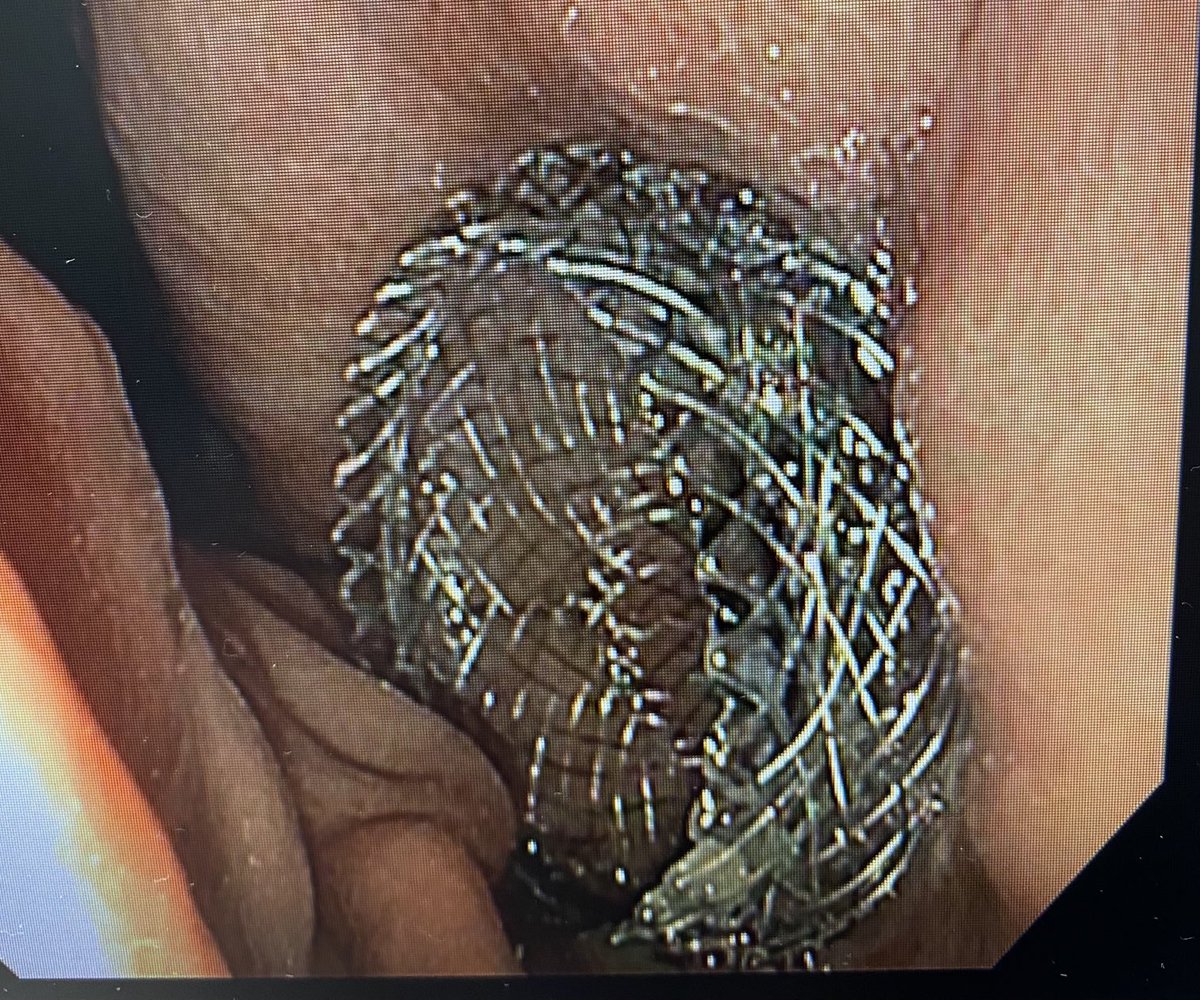 VMehendirattaMD's tweet photo. Capped off the inpatient week ⁦@hartfordhosp⁩ #giconsult service with #EUS Guided Gastrojejunostomy using #Axios stent for malignant duodenal obstruction https://t.co/3jd7wwdbiz