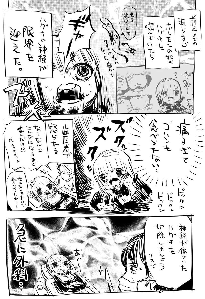 歯茎を噛み続けた結果？歯茎を切除する羽目に！