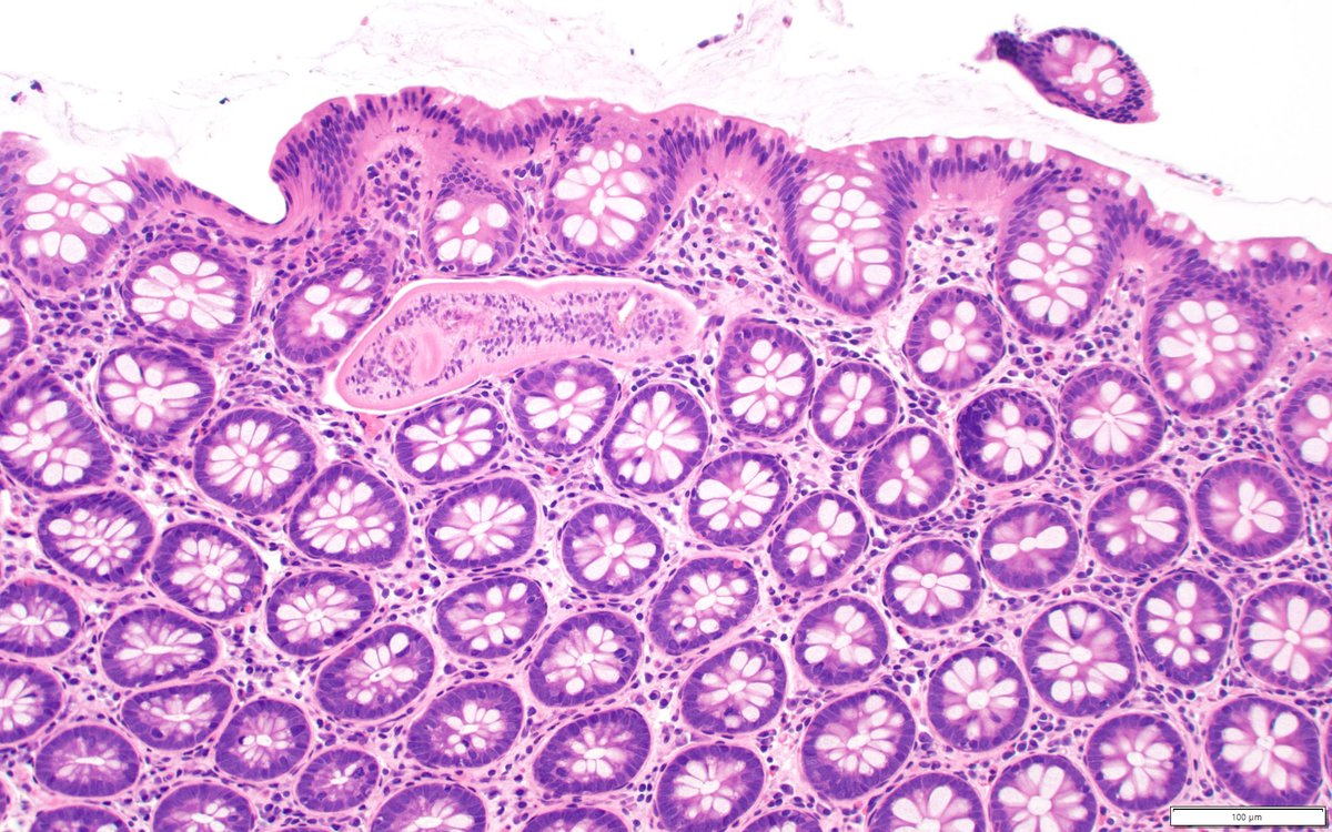 The Parasite Case of the Week 632 is up: a fun histopath case with a twist: parasitewonders.blogspot.com/2021/03/case-o… 

#asmclinmicro #MayoClinMicro #mayopath #parasites #path2path #pathology <a href="/JMGardnerMD/">Jerad Gardner, MD</a> <a href="/mayocliniclabs/">Mayo Clinic Labs</a> <a href="/ASTMH/">ASTMH</a> <a href="/Pathologists/">CAPathologists</a> <a href="/AmSocParasit/">ASP-Parasitologists</a> <a href="/LSHTM/">London School of Hygiene & Tropical Medicine</a>