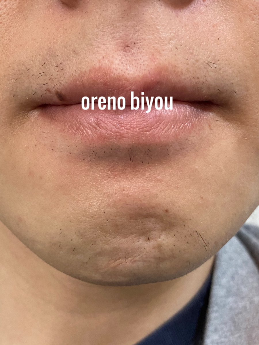 剛毛男爵 脱毛アドバイザー 実績360人超 ヒゲ脱毛8回目 施術4日後 全体的に毛が目立ってきたね 産毛も