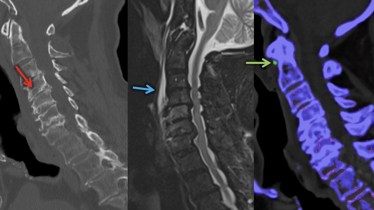 Miriam_Peckham's tweet photo. Pt with neck pain - “rat bite” erosions along endplates c/w gout, but why the prevertebral edema? Dual energy to the rescue! No active urate crystal (green) deposition at endplates, instead at insertion of longus colli in this case of gout tendinopathy #spine #FOAMrad #UofUspine https://t.co/HoYEECIHsD