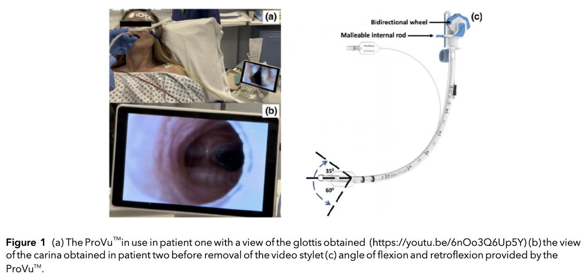 🔐Awake tracheal intubation with the ProVu™ video stylet: a case series #FreeForAWeek

Watch it here!
👀youtube.com/watch?v=6nOo3Q…

<a href="/siewmoff/">Siew</a> <a href="/dr_imranahmad/">Imran Ahmad</a> <a href="/AlexaCurtis20/">Alexa Curtis</a> <a href="/gunjeet99/">Gunjeet Dua</a> <a href="/c_johnstone1980/">Craig Johnstone</a>

🔗 …-publications.onlinelibrary.wiley.com/doi/full/10.10…