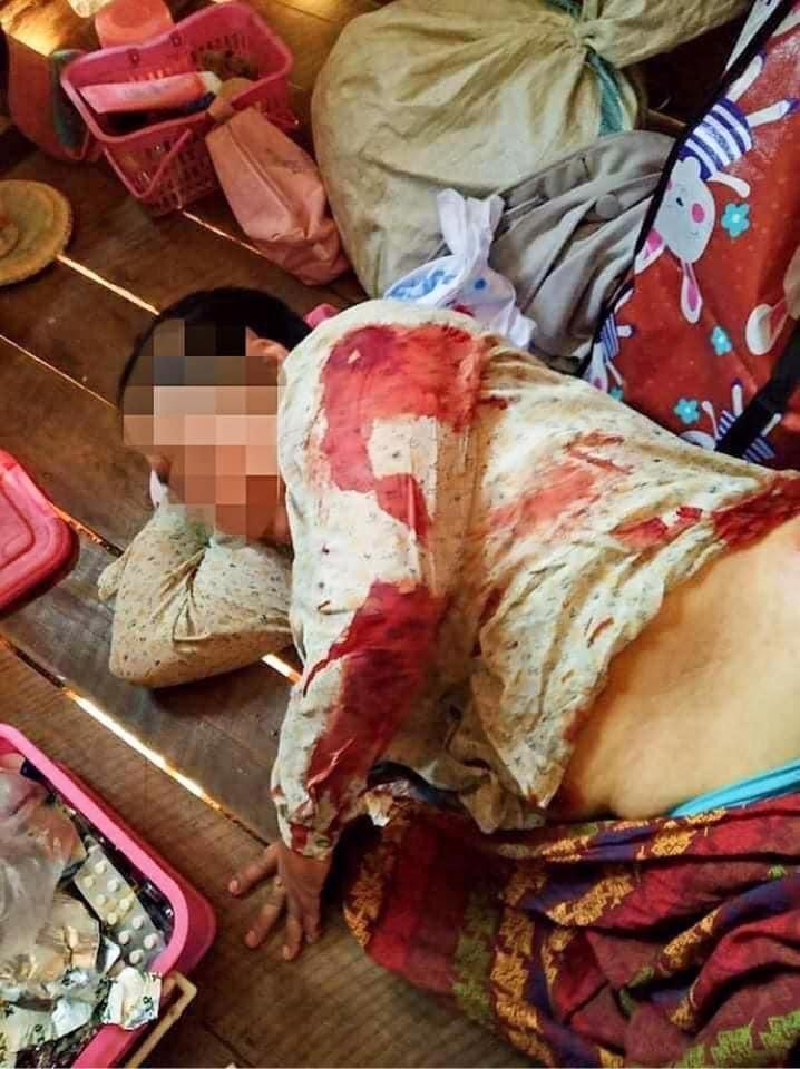 MilkTeaMM_MTAM's tweet photo. Tw // blood
[Terrorists Abuse on Elder]:Junta's forces came &amp; abhorrently cracked down even before the protest start. They also shot 9 times to 60 years old woman who's just sitting in the house with rubber bullets in #Loikaw, Min Su ward. #WhatsHappeningInMyanmar #Mar30Coup https://t.co/sAxcx8BZgq