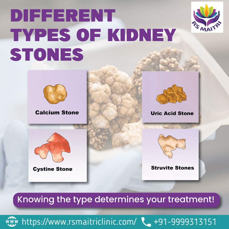 Types Of Kidney Stones