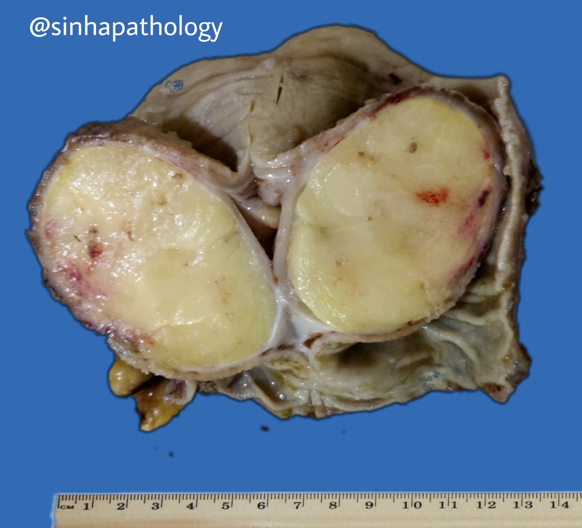 Anshuman Sinha MD tweet media