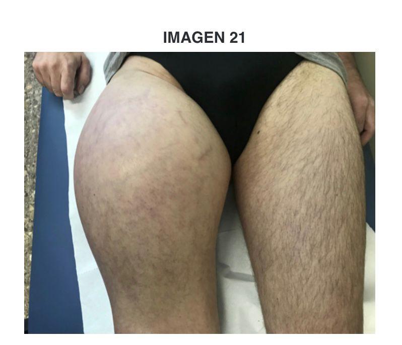 Qué opinan de esta pregunta especialistas en sarcomas? <a href="/DrOrtizCruz/">Eduardo Ortiz Cruz</a> <a href="/mangulosa/">Manuel Angulo</a> <a href="/Dr_IsraelPerez/">Dr Israel Perez</a> #MIR2021 <a href="/LuisAlberto3P/">Dr. Luis A. Pérez-Romasanta</a> @