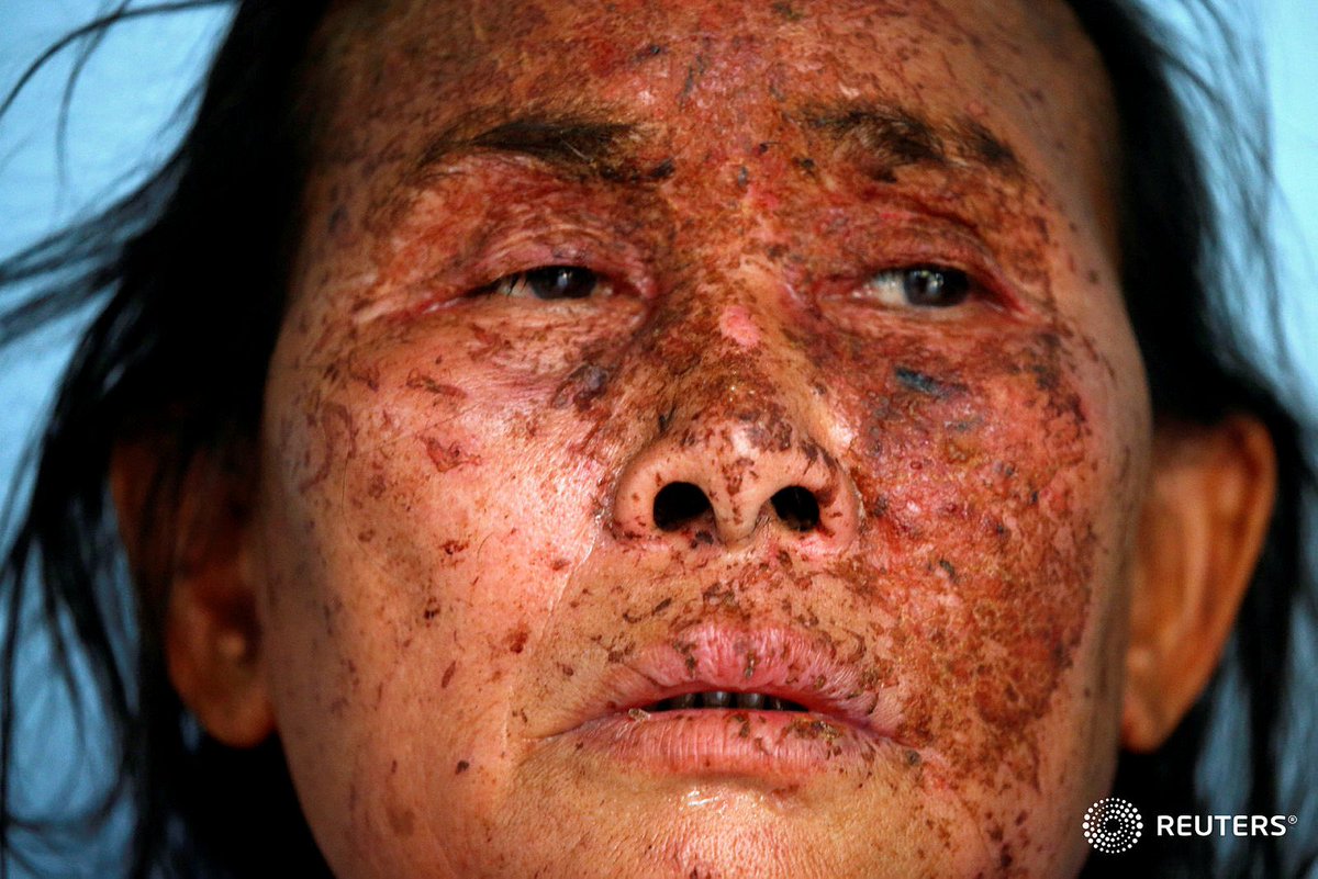 A wounded person who is fleeing the violence in Myanmar seeks medical treatment at the Thai border village of Mae Sam Laep, Mae Hong Son province, Thailand March 30, 2021. REUTERS/Soe Zeya Tun #WhatsHappeningInMyanmar