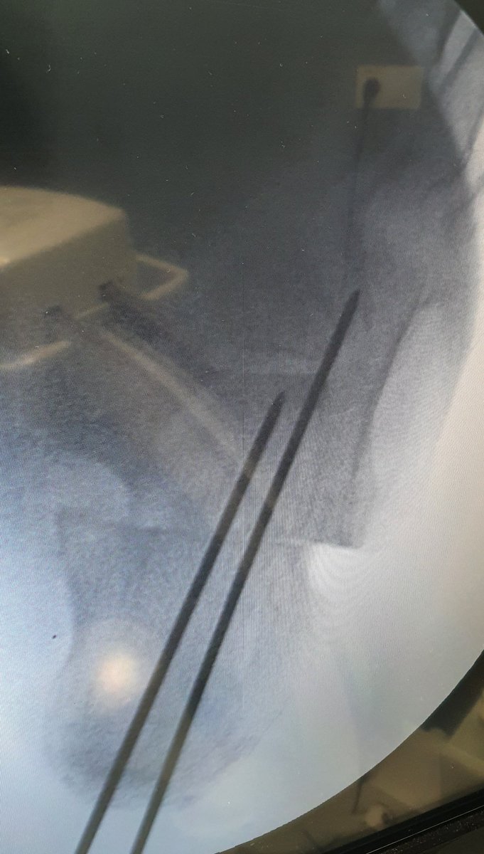 RNOrtizCOT's tweet photo. Osteotomía varizante de calcáneo. Control intraoperatorio. Una buena corrección se controla también en la proyección axial.

#calcaneous #trauma #osteotomy @secotsecot @semcpt1 https://t.co/7ElzXw57Yy
