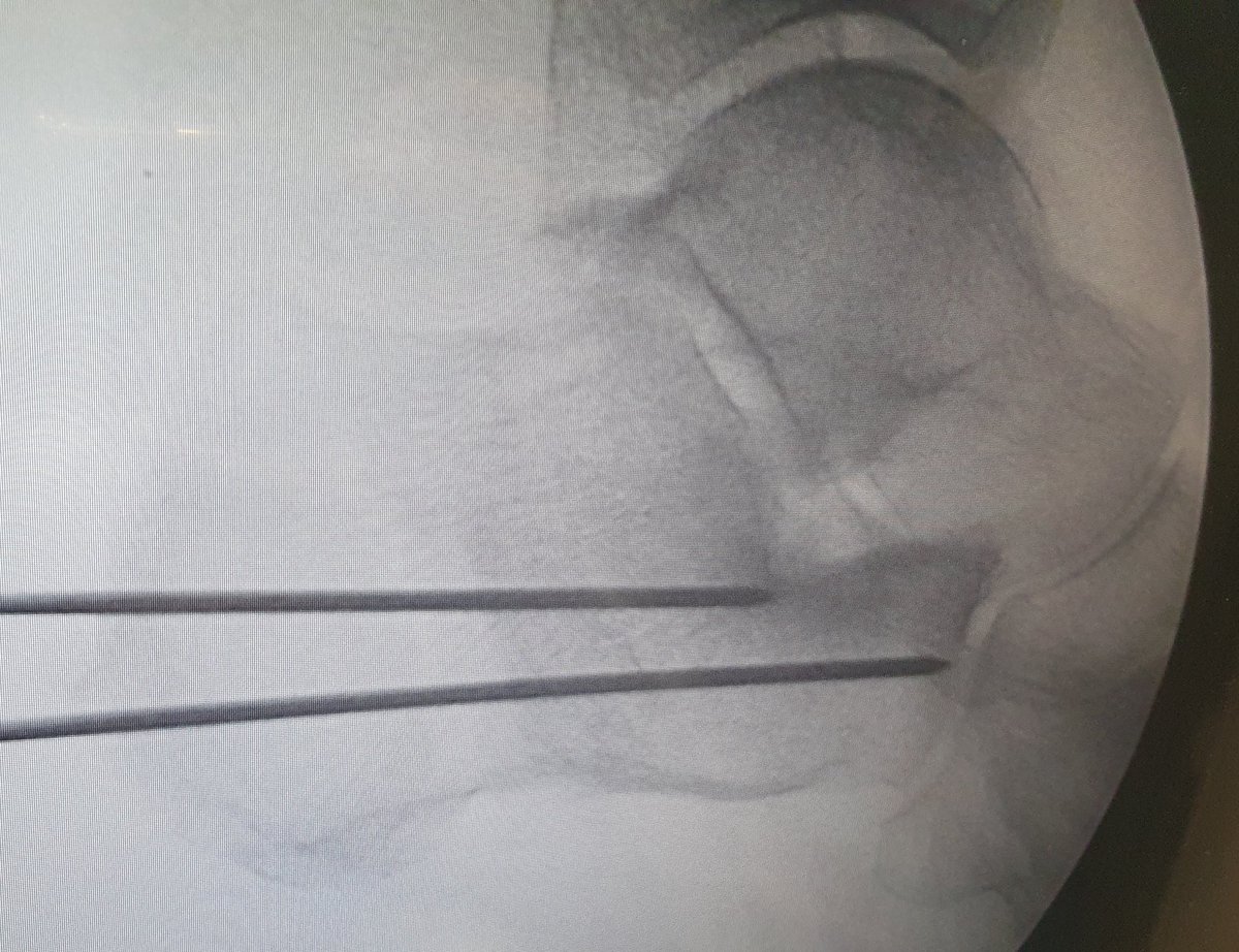 RNOrtizCOT's tweet photo. Osteotomía varizante de calcáneo. Control intraoperatorio. Una buena corrección se controla también en la proyección axial.

#calcaneous #trauma #osteotomy @secotsecot @semcpt1 https://t.co/7ElzXw57Yy