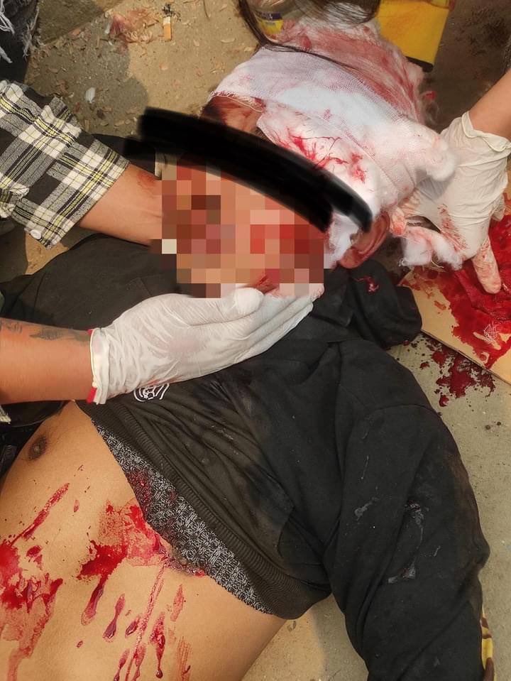 zayerlynn's tweet photo. Tw // blood // wound
In Muse, Shan State a man was shot in the head with sniper by junta’s terrorists.
ABOMINABLE CRUELTY
#WhatsHappeningInMyanmar 
#Mar30Coup https://t.co/tLvGNlcZBw