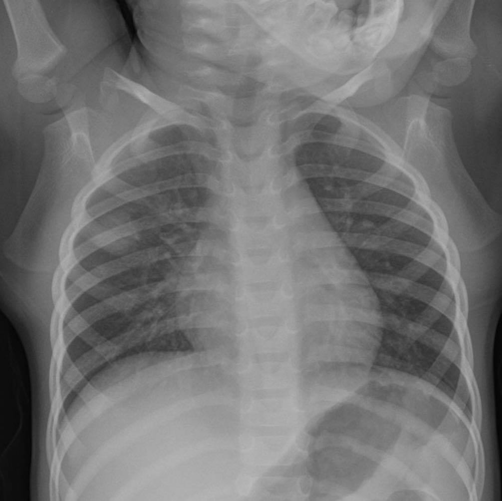 Q: 1 year old boy with fever. Have a look around, what do you see?
ANSWER: bit.ly/3nP0EPF
#FOAMrad #FOAMed