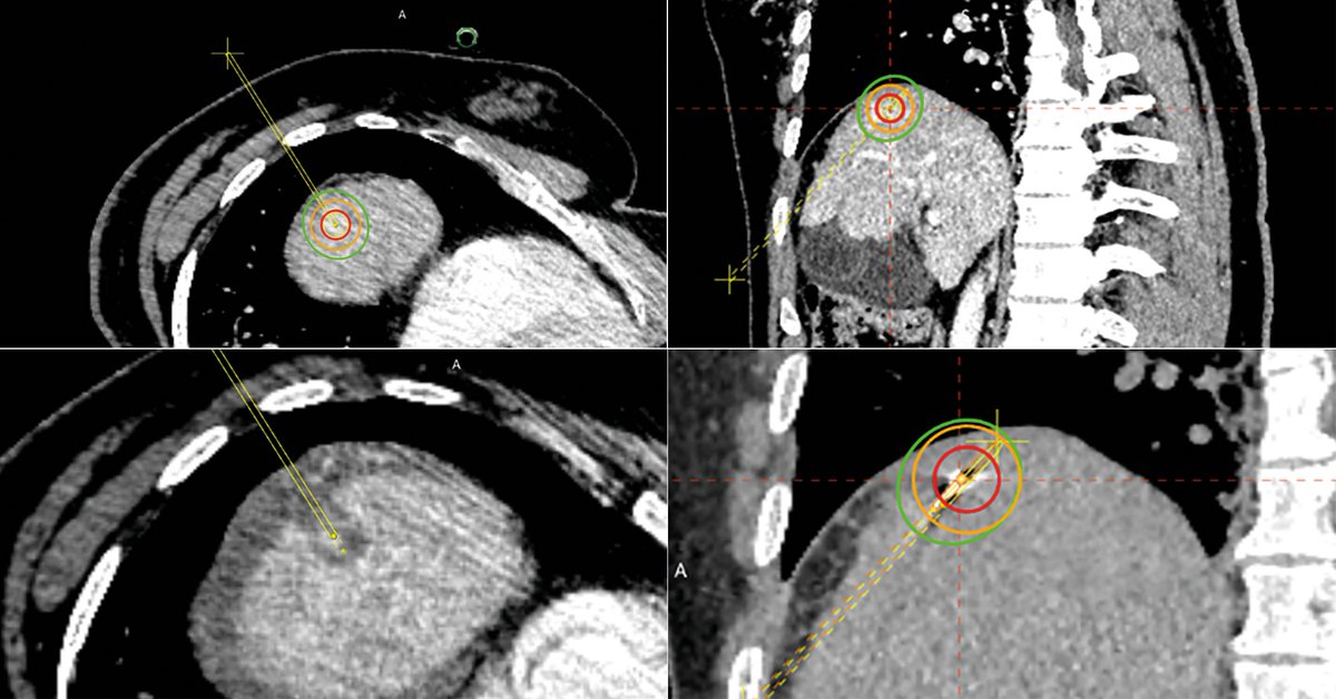 CAScination's tweet photo. Another CAS-One IR Quality Ablation TOP CASE of 2021 - an HCC in segment VIII of the liver - without Quality Ablation resection would have been very challenging - Thanks to Dr. Mohnish Palaniswamy from @Gleneagles_GH, #qualityablation #cancertreatment
https://t.co/F5T34tKgSu https://t.co/vU8ikpRnp9
